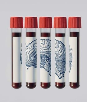 ΑΝΟΙΑ ΕΞΕΤΑΣΗ ΑΙΜΑΤΟΣ ΑΛΤΣΧΑΙΜΕΡ