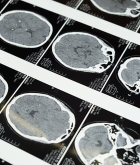 Τι είναι το ανεύρυσμα εγκεφάλου και πώς αναγνωρίζεται πριν από μια ρήξη;