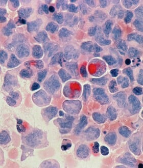 ΚΑΡΚΙΝΟΣ ΝΕΟΙ ΑΥΞΗΣΗ ΑΓΓΛΙΑ